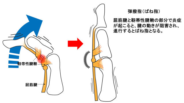 透析アミロイドーシスの症状3