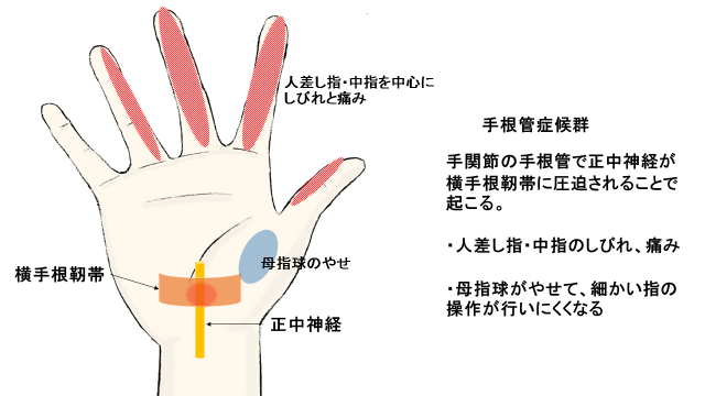 透析アミロイドーシスの症状