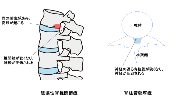 手・関節の痛み】透析アミロイドーシスについて徹底解説 | 東京で透析 