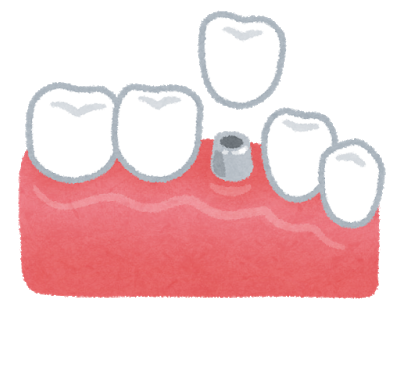 インプラント治療